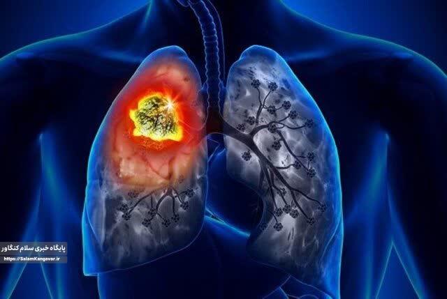 چه بلایی سرِ “ریه” سیگاری ها می آید؟