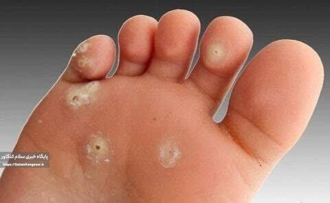 چرا پا “میخچه” می زند؟