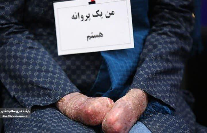 شناسایی ۳۰ بیمار “پروانهای ” در کرمانشاه