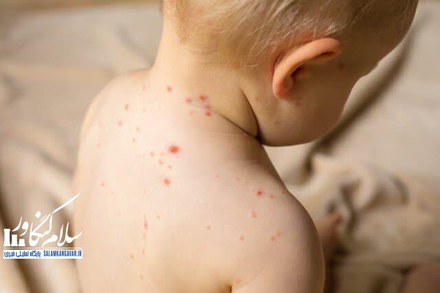 همه چیز در مورد آبله مرغان!