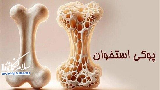 چطور جلوی «پوکی استخوان» را بگیریم؟